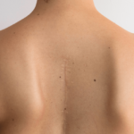 σκολίωση πώς θεραπεύεται