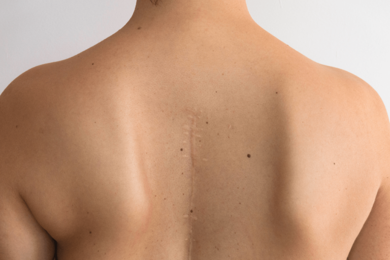 σκολίωση πώς θεραπεύεται